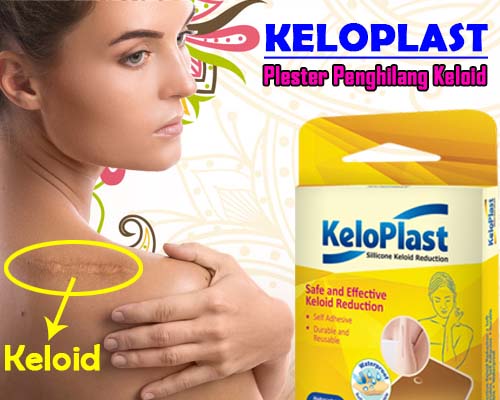 Keloplast