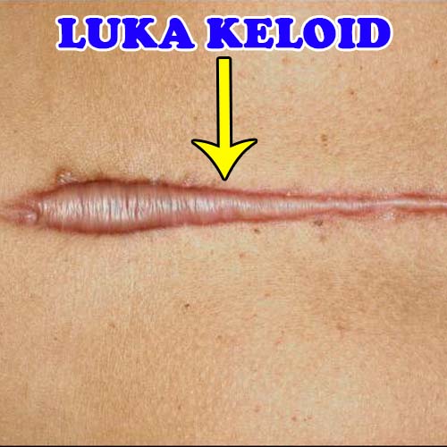 Luka-Keloid