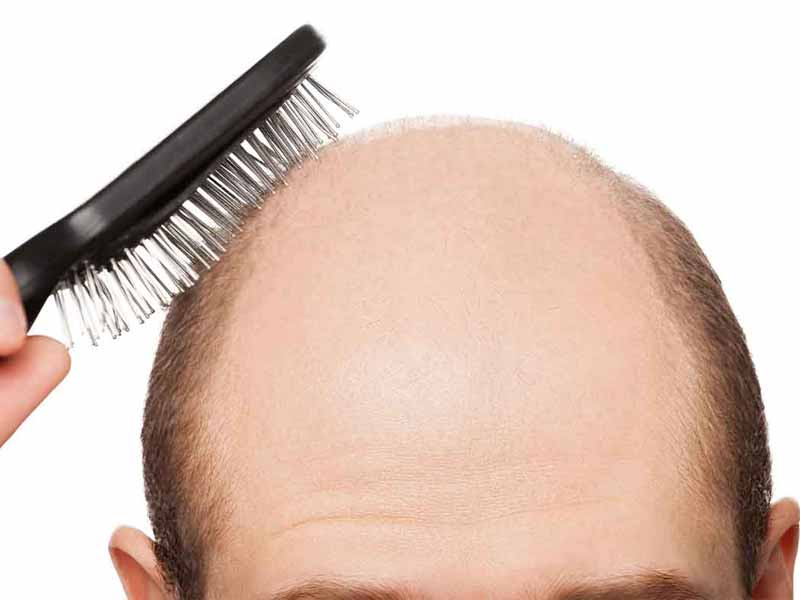cara alami atasi rambut botak