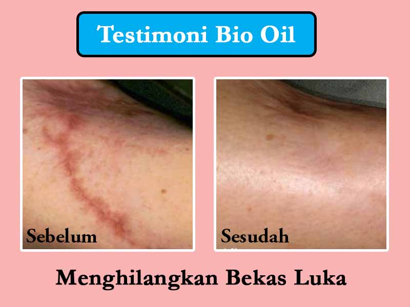 Bio Oil Indonesia Review 